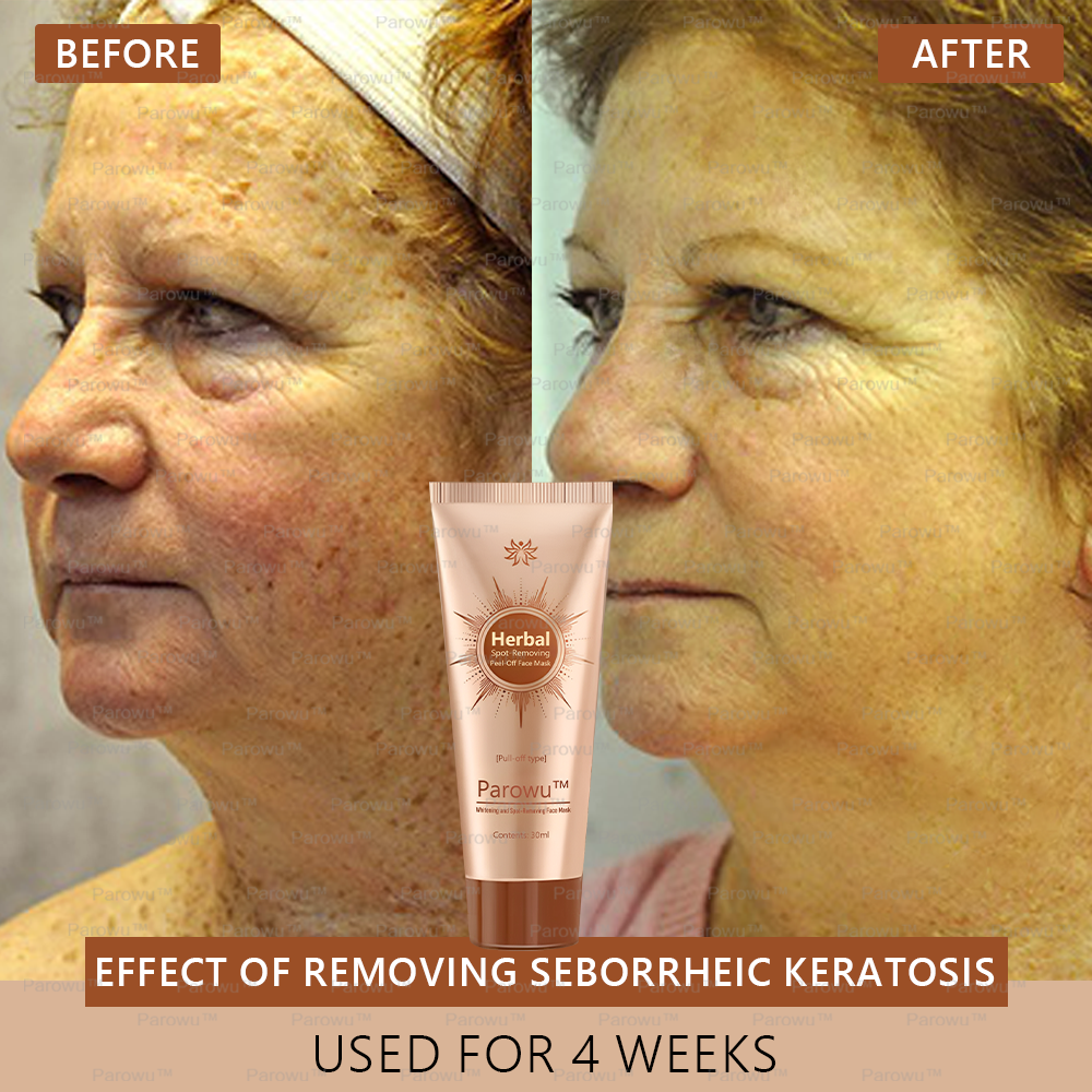 đ”ïž Parowuâą Whitening and Spot-Removing Face Mask Suitable for face and body â đ©ââïž Natural ingredients permanently remove age spots, freckles, sun spots, and liver spots.