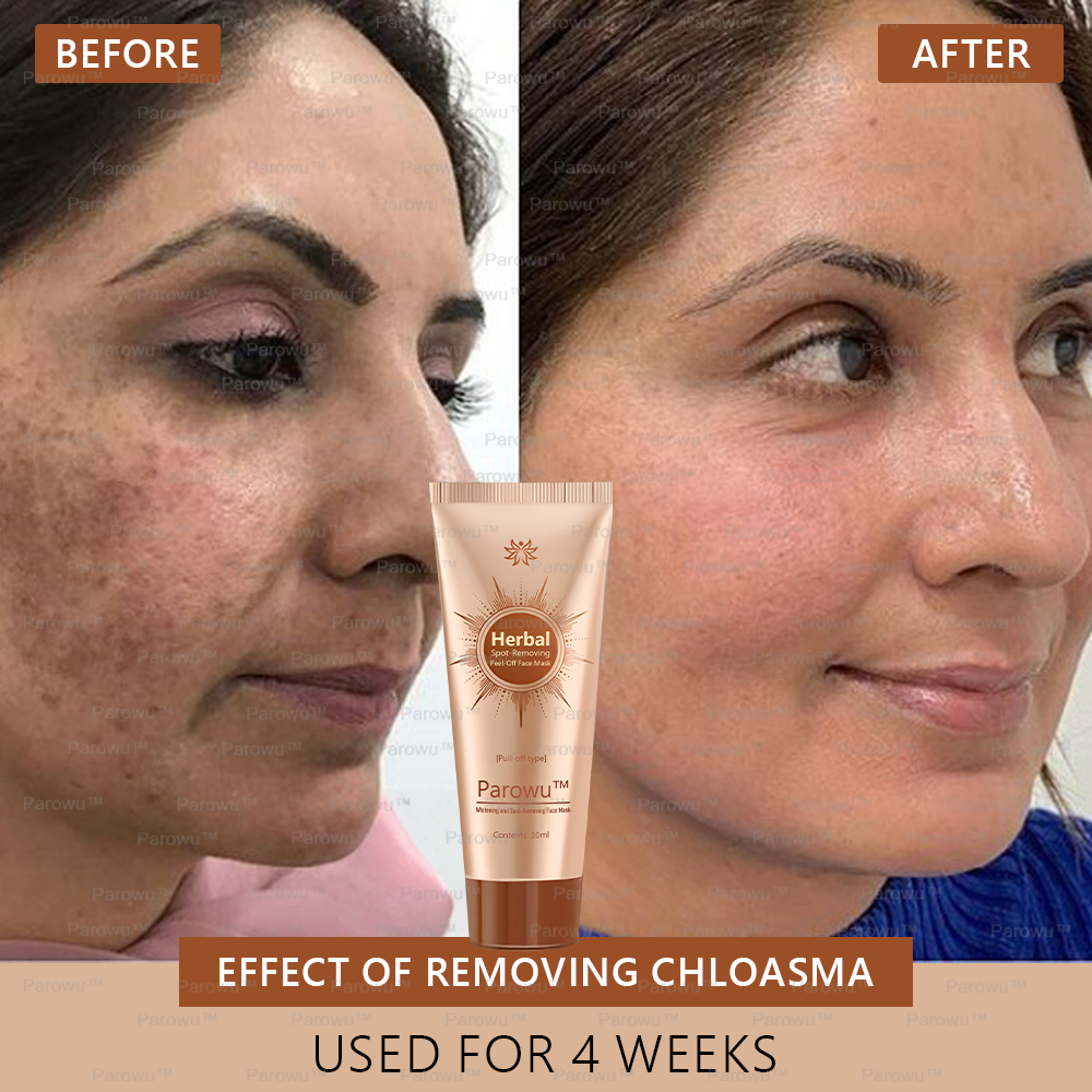 🏵️ Parowu™ Whitening and Spot-Removing Face Mask Suitable for face and body – 👩‍⚕️ Natural ingredients permanently remove age spots, freckles, sun spots, and liver spots.