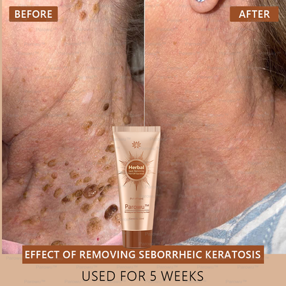 🏵️ Parowu™ Whitening and Spot-Removing Face Mask Suitable for face and body – 👩‍⚕️ Natural ingredients permanently remove age spots, freckles, sun spots, and liver spots.