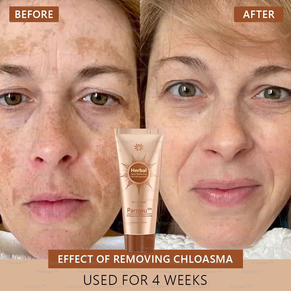 🏵️ Parowu™ Whitening and Spot-Removing Face Mask Suitable for face and body – 👩‍⚕️ Natural ingredients permanently remove age spots, freckles, sun spots, and liver spots.